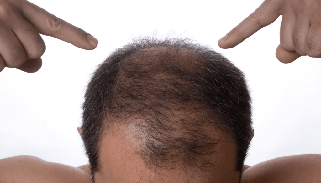 alopecia