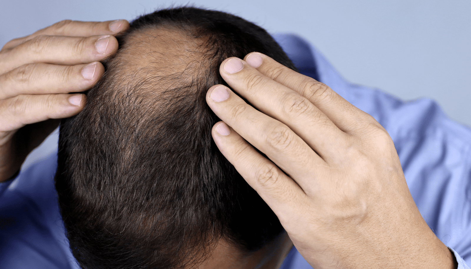 alopecia-androgenetica